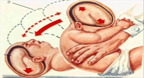 síndrome do bebê sacudido